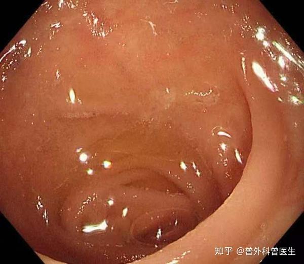 而结肠黑变病的肠粘膜是这样的