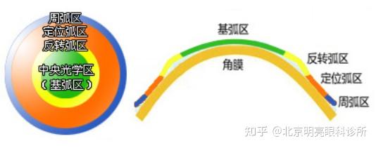 mct角膜塑形镜青少年视力解决方案