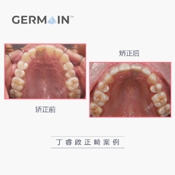 矫正前下颌后缩,牙齿前突的姑娘,她左上的情况比较特殊,缺了一颗4号