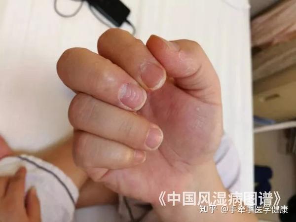 指甲有这种表现,可能是银屑病关节炎