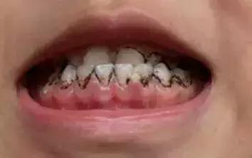 小朋友牙齿上的黑色素能去掉吗