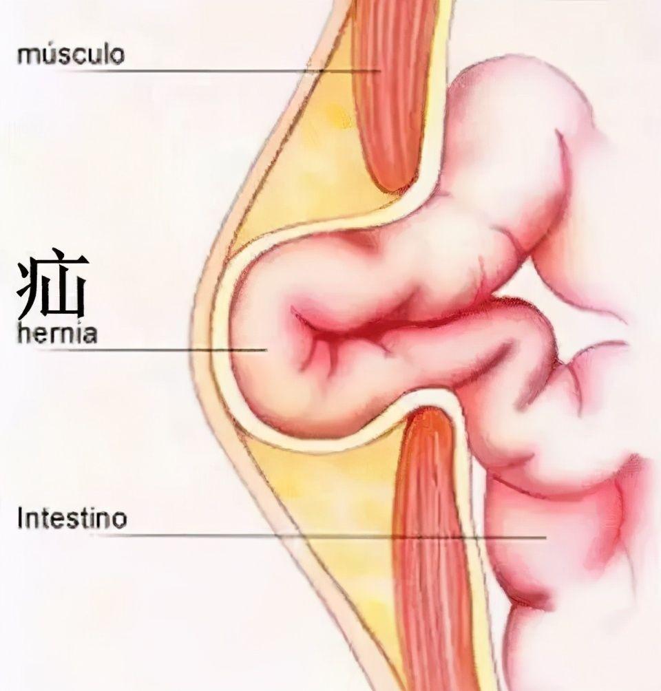 博士在读 1 人 赞同了该文章 一旦疝内容物还纳困难,就会发展为嵌顿疝