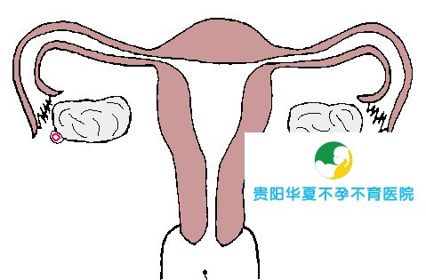 疏通输卵管解决多囊华夏助她获好孕