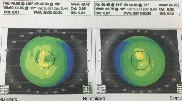 患者原始角膜地形图如下