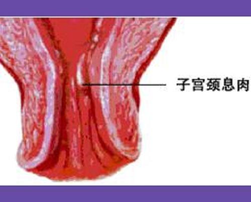 宫颈息肉容易发作的原因