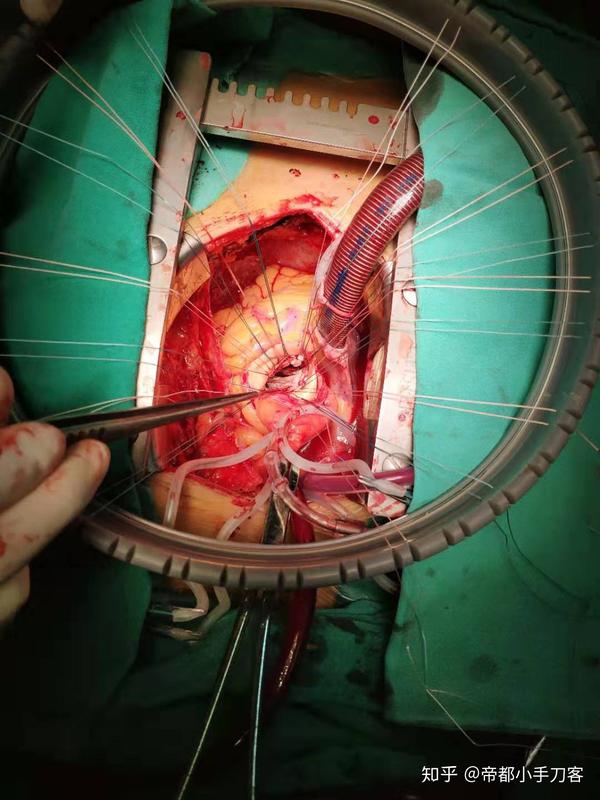常规主动脉瓣手术的切口