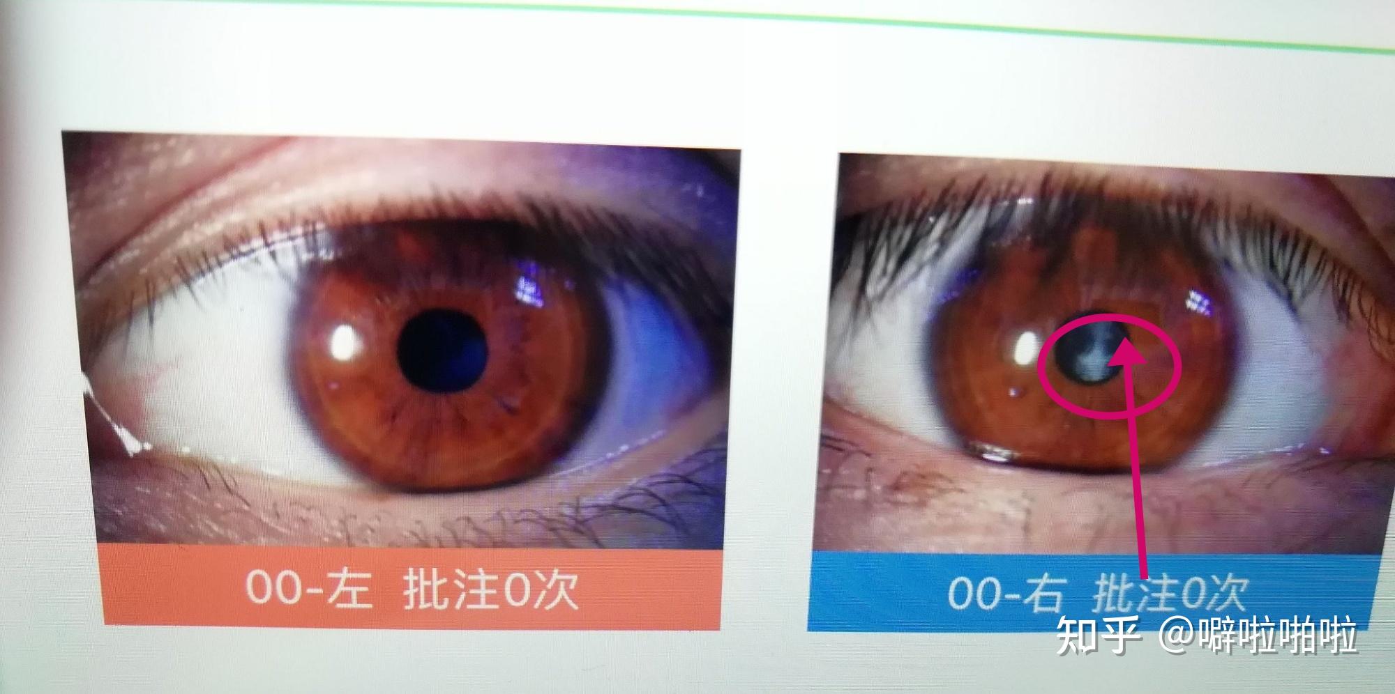如何关注眼健康白内障