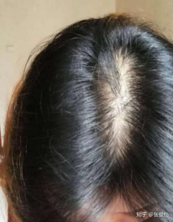 女生头发细软,很容易出油,掉的多,现在特别少怎么办?