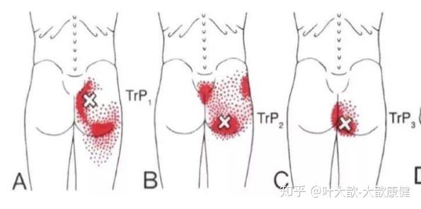 被冤枉的肌肉3:臀部痛与臀大肌损伤