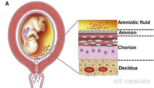 急性绒毛膜羊膜炎是什么引起的