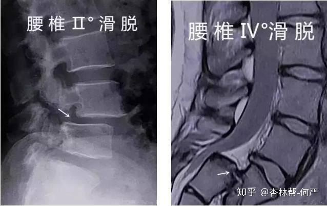 腰椎滑脱分几度?哪些情况要手术?