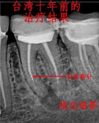 恐怖!做牙根管治疗时,针断在了牙根怎么办?