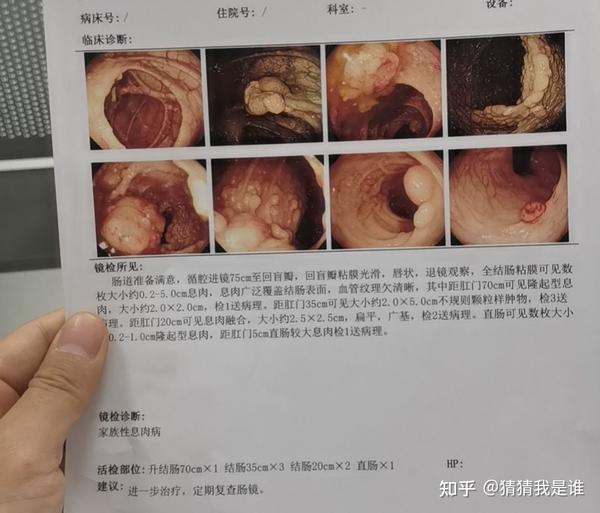30岁家族性肠息肉患者,大肠全部切除,还没手术呢
