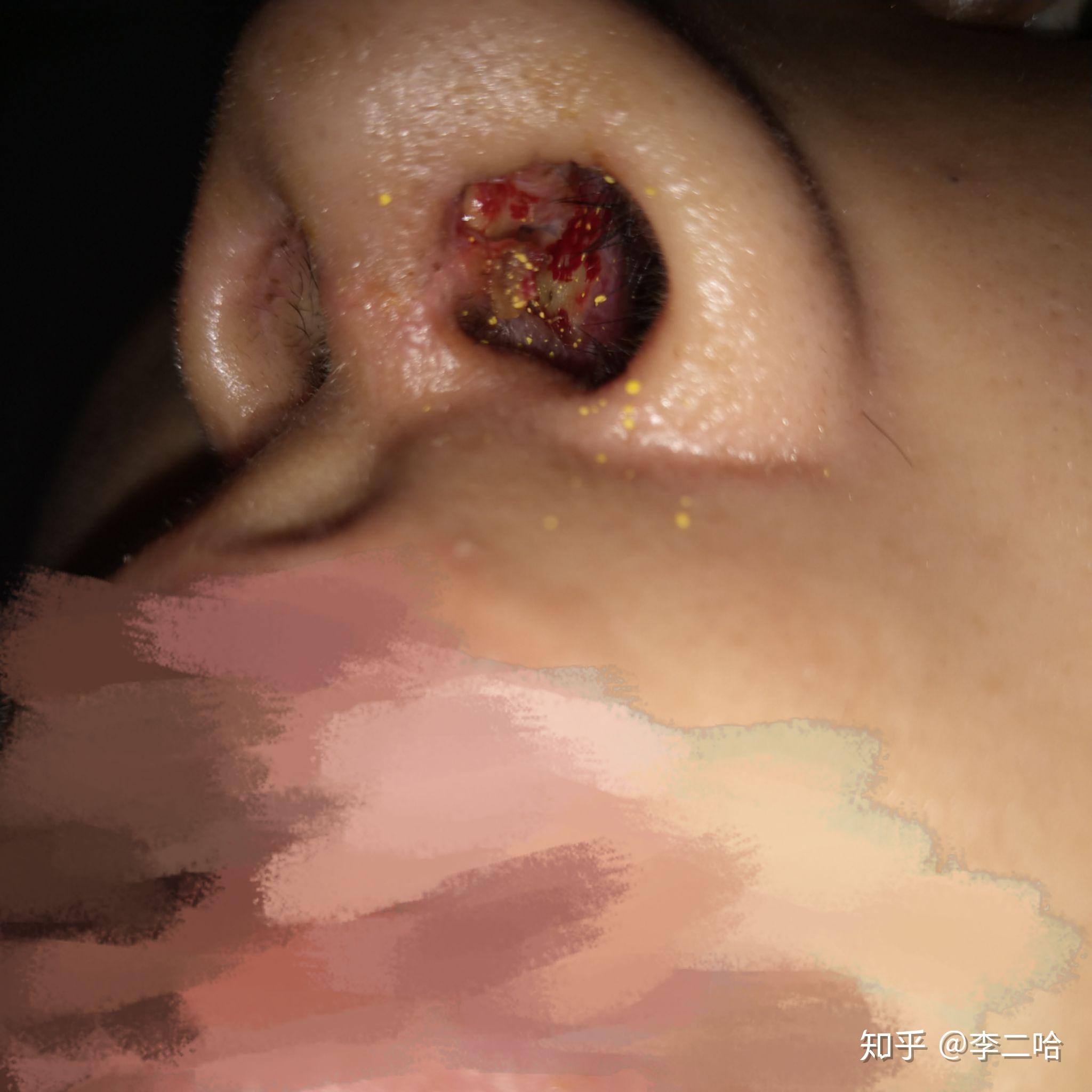 在上海某家整形医院进行隆鼻手术导致鼻子里面溃烂