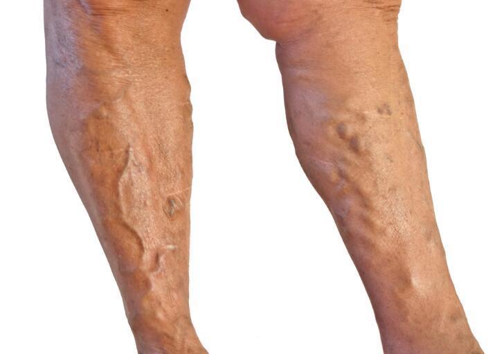 关注腿健康应对蚯蚓腿青筋暴露下肢静脉曲张的医学知识