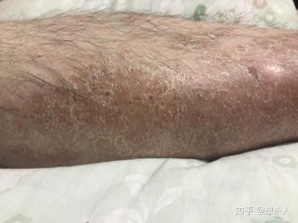 牛皮藓治愈过程