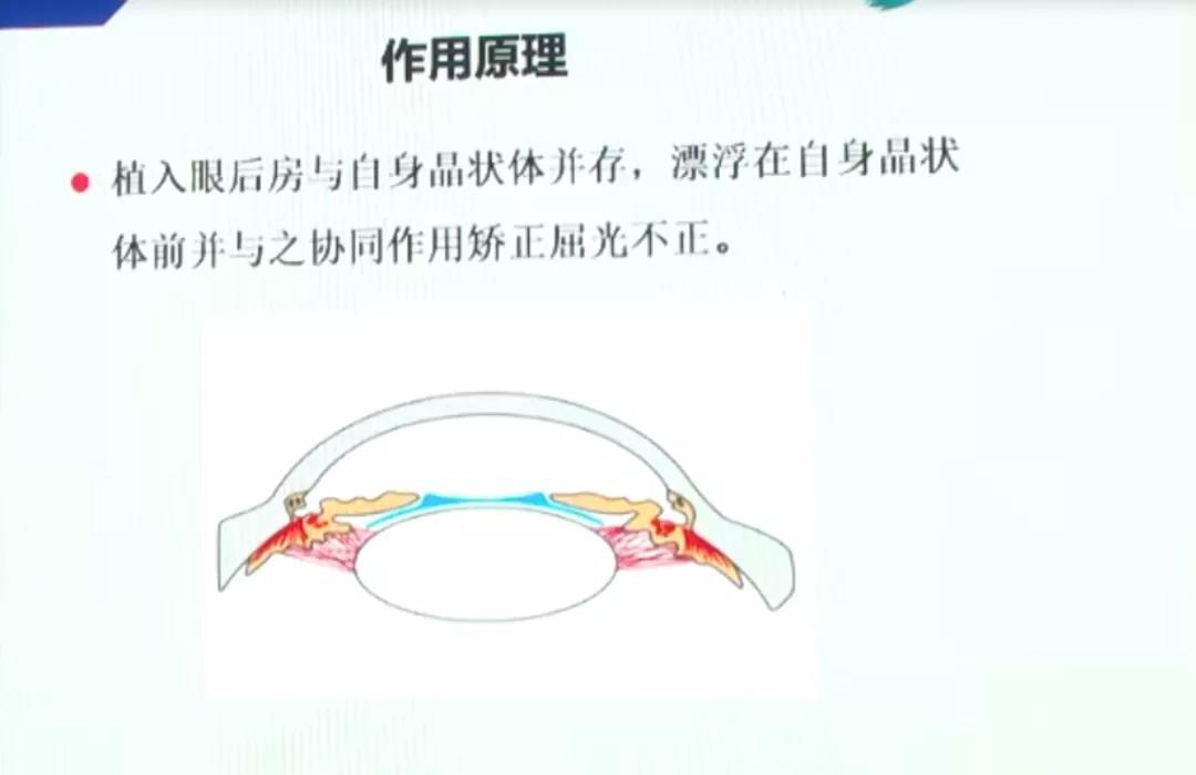 作用原理是植入眼后房,悬浮在自身晶状体前,并与之协同作用矫正屈光不