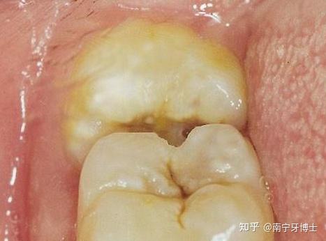 微创拔牙丨隐秘的智齿最痛的领悟
