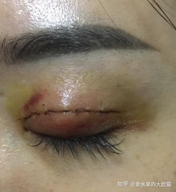 不晓得是不是我吃鱼的原因,而且出现了可怕的线结反应,一边庆幸自己没
