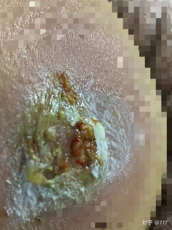 火疖子疖肿抗战记!