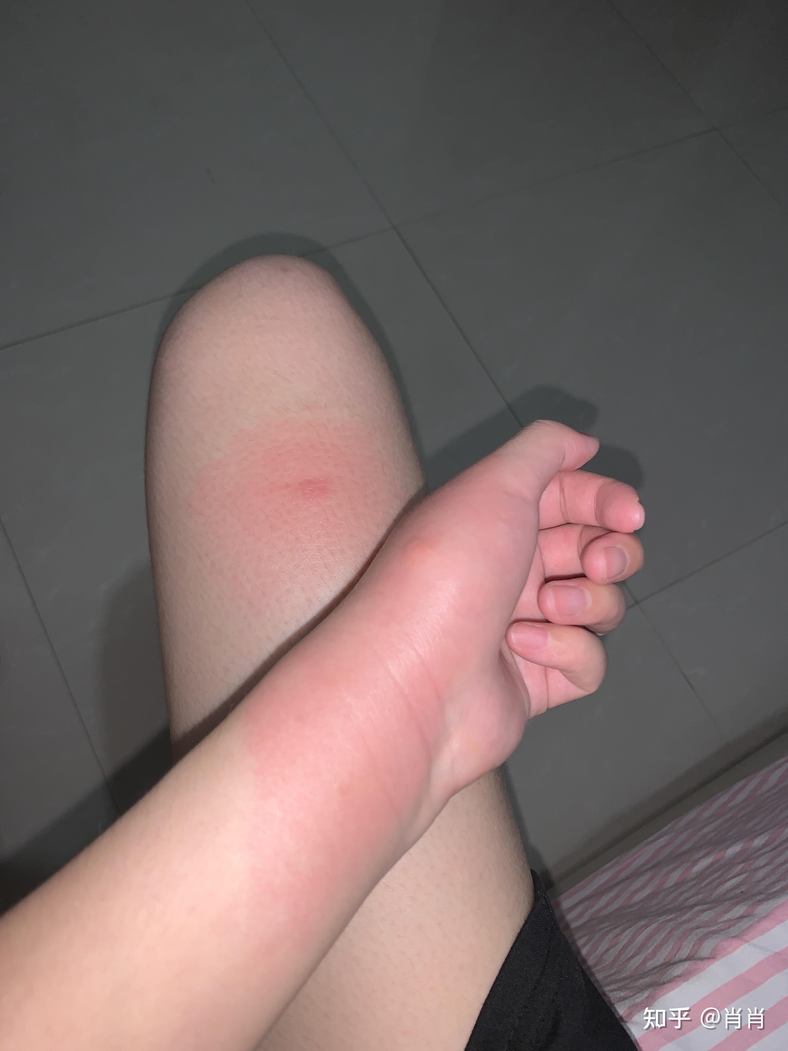 为什么蚊子咬完会肿起来一大片硬包还很热周围皮肤是凉的是我的免疫