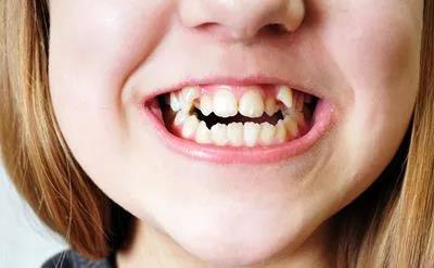 成都牙科医生科普:儿童错颌畸形早期干预的重要性!