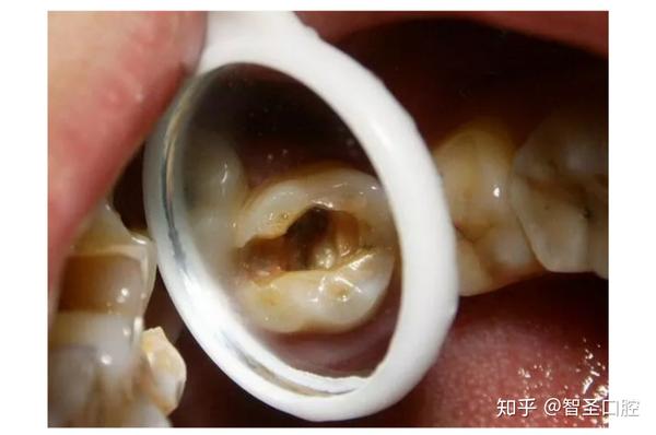 脏污的东西或腐败的食物残渣很容易掉进牙齿内的破洞,造成更严重的