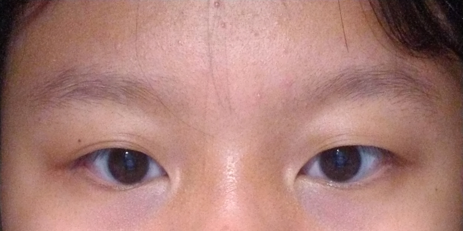肿泡眼是什么