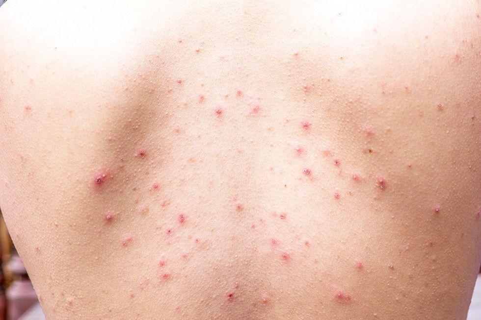 背上反复长痘痘有什么有效方法祛除痘痘和痘印吗