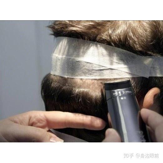 一方面是因为移植自己的不会出现排异性,另一方面就是后脑勺的毛发