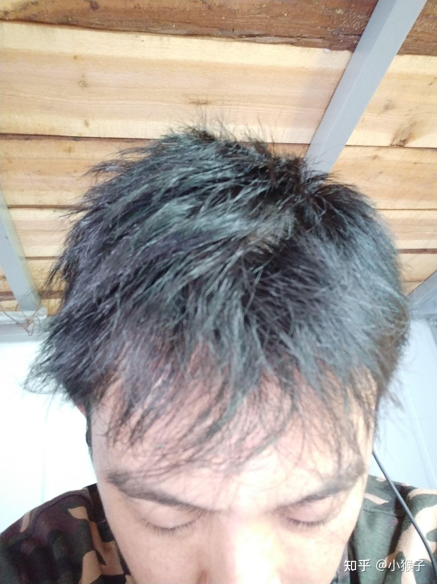 雄激素脱发吃药第二个月