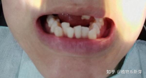 准备拔牙(取下牙套,上面有个歪牙齿,拔下门牙左2,右2)