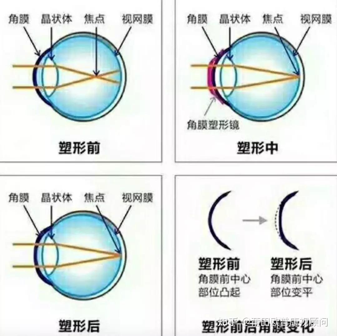 0以上.当然,罗马不是一天建成的的,角膜塑形也需要时间.