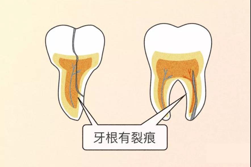 就算是健康的牙齿也受不住,牙隐裂就向你招手啦.