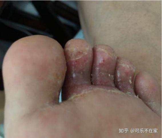 脚脱皮是脚气症状吗儿童为什么会得脚气是真菌感染吗