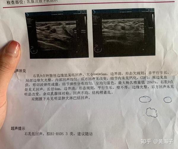 乳房里的小疙瘩到底是什么?