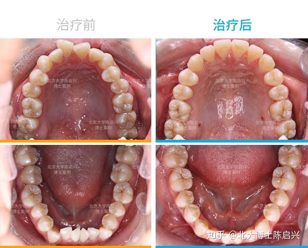 单纯正畸骨性开颌牙齿矫正案例