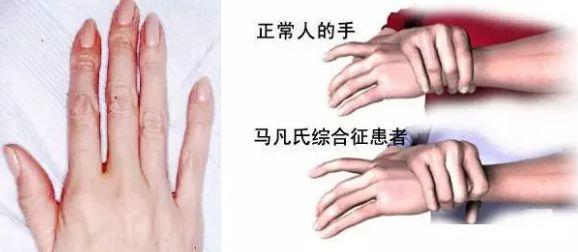 马凡氏综合征基因检测能防止后代遗传吗