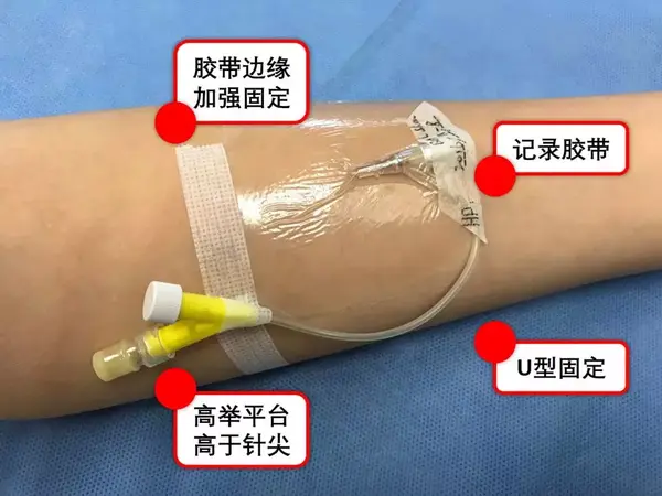 固定前臂y型留置针流程分步走