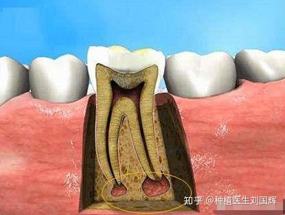 实际上,根尖周炎其实就是牙根尖周围口腔组织发生了病变.