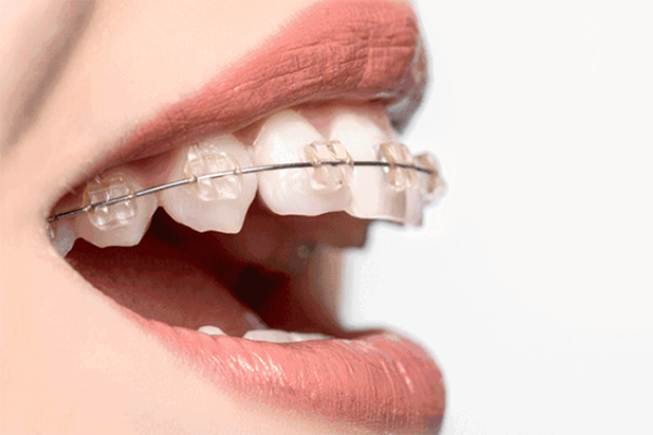合肥牙齿矫正价格-整牙要多少钱?
