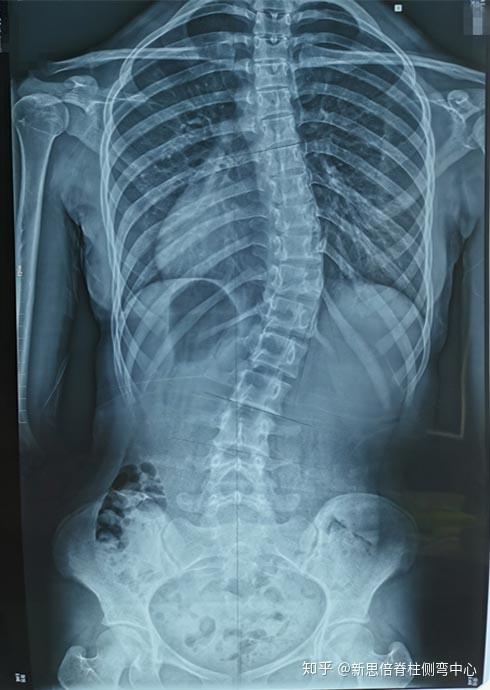 介绍是体考坐位体前屈时发现背部不平,进而去医院检查发现了脊柱侧弯