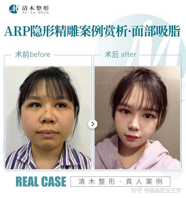 面部吸脂手术过程【真实案例分享】