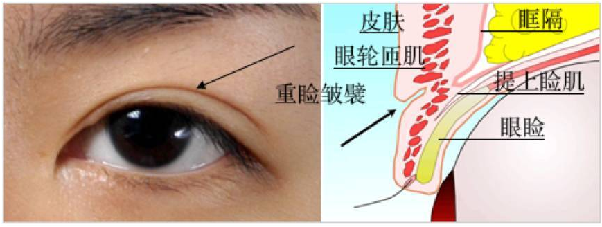 双眼皮手术的干货