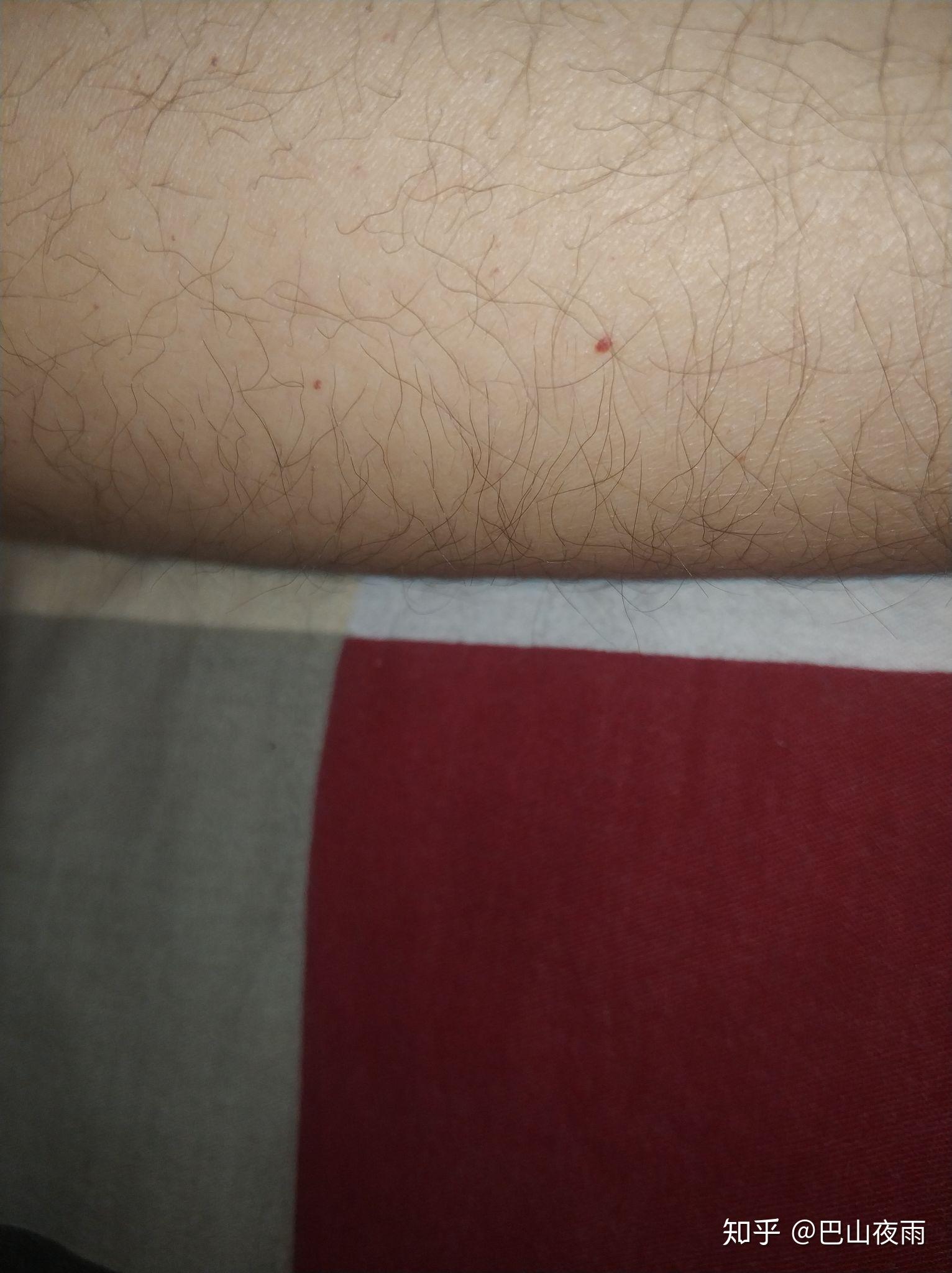 皮肤上的红色小血点是什么