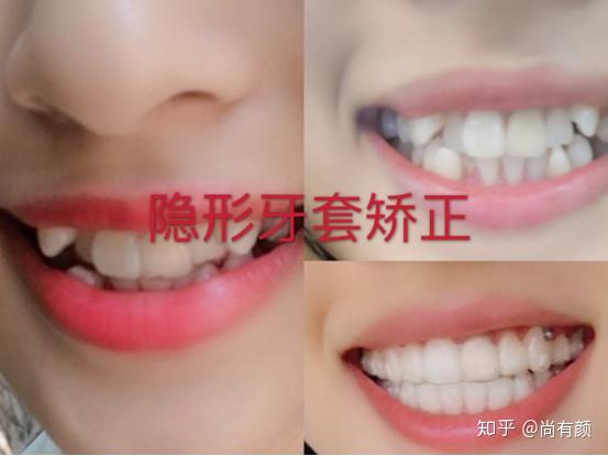 牙齿矫正是隐形牙套矫正好还是传统钢丝牙套矫正好?