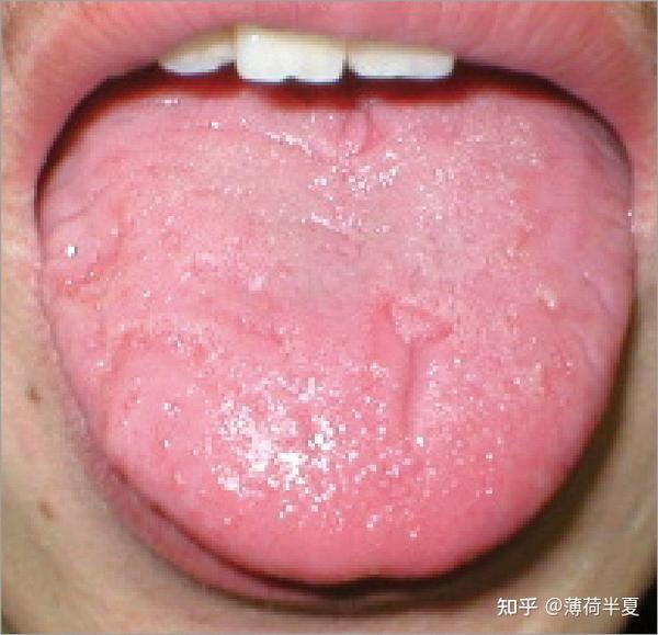 裂纹舌(1)