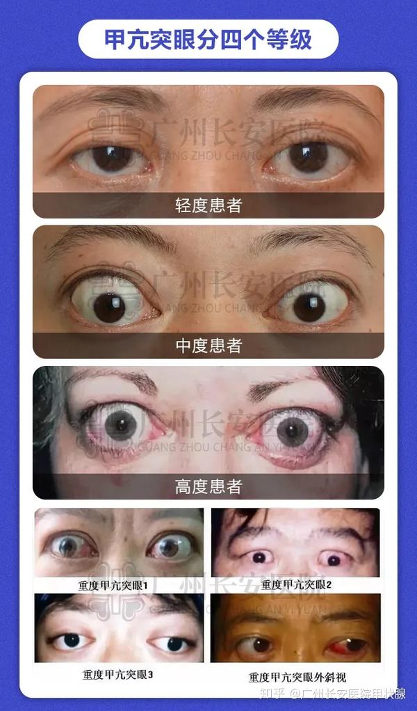 2,中度甲亢突眼:当甲亢突眼发展至中期,眼球突出较明显,白眼仁增多