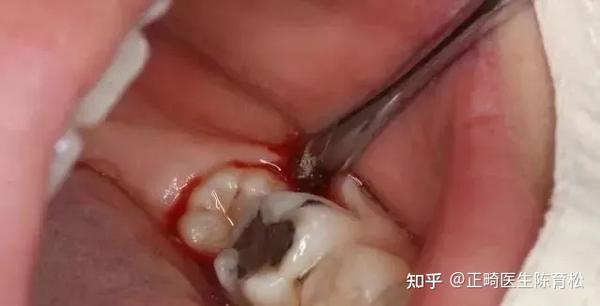 小孩子去拔牙要打麻药?对发育有影响吗?