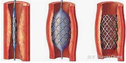 主动脉及外周血管介入治疗产品